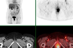 2017 09 12 22 45 5665 Pet Ct Anal Cancer Jnm 400