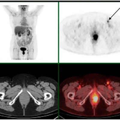 2017 09 12 22 45 5665 Pet Ct Anal Cancer Jnm 400