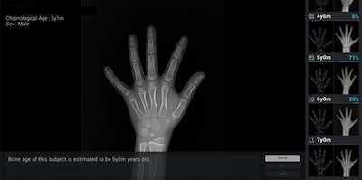Bone age assessment provided by deep learning-based software on the wrist radiograph of a boy with a chronological age of 5 years and 1 month. The software's first-rank estimate of bone age was 5 years with a probability of 71%. The second- and third-rank bone ages were 6 years (23% probability) and 4 years and 6 months (6% probability). Image courtesy of AJR.