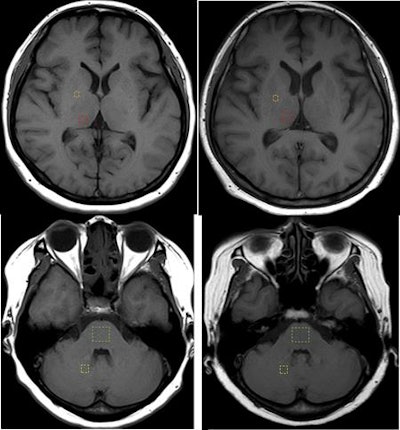 Axial T1-weighted MR images show regions of interest in the quantification of signal intensity (dashed lines) for the globus pallidus, thalamus, dentate nucleus, and pons. Globus pallidus and thalamus images (upper row) are from the first scan and after 21 administrations of macrocyclic ionic GBCA. Also shown are the dentate nucleus and pons (lower row) from the first scan and after 21 administrations of macrocyclic ionic GBCA. Image courtesy of PLOS One.