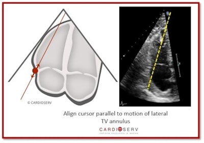 Align cursor parallel to motion of lateral TV annulus