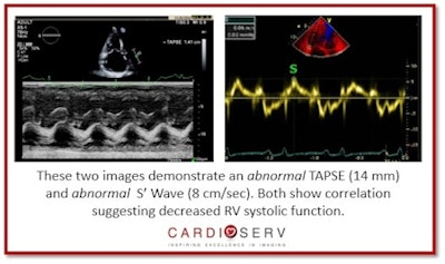 Abnormal TAPSE and abnormal S