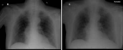 A comparison of the original radiograph rejected by the technologist (left) and the repeat radiograph (right) sent to the radiologist. Images courtesy of Dr. Andrew Rosenkrantz.
