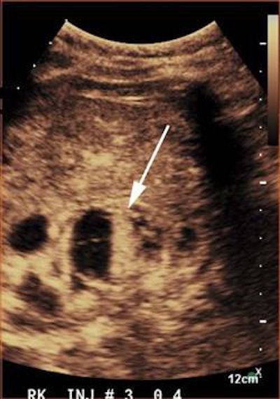 CEUS showed a mixed solid and cystic lesion with enhancement of the solid component (arrow). This lesion was classified as potentially malignant, class B, and was a clear cell renal cell carcinoma on histopathologic examination. Image courtesy of the Journal of Ultrasound in Medicine.