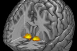 2017 09 21 21 59 7409 F Mri 3 D Brain Activity 400