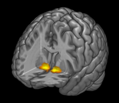 3D fMR image represents reward-related activity in the brain's ventral striatum. Participants with higher activity in this region were less likely to have symptoms of depression when experiencing poor sleep quality. Image courtesy of Duke University.