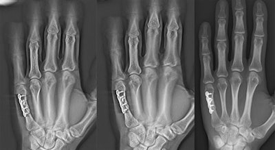 DTS (left, middle) sharpens visualization of fracture healing compared to DR (right). Image courtesy of Dr. Thomas Frauenfelder.