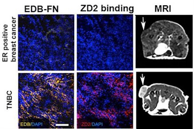 Images show the different expression of the biomarker (EDB-FN) and probe binding (ZD2) in slow-growing estrogen receptor-positive breast cancer (ER-positive, low expression of the biomarker and low binding) and in triple-negative breast cancer (TNBC, high expression and high binding). As a result, the contrast agent produced weak signal enhancement (brightness) in the former and strong signal in the latter (arrow). Images courtesy of Case Western Reserve University.