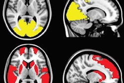 2017 09 26 23 57 1597 Hepp Parkinson Hallucinations 20170926234319