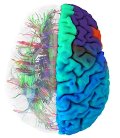 A healthy brain connectome. Image courtesy of Mint Labs/Qmenta.