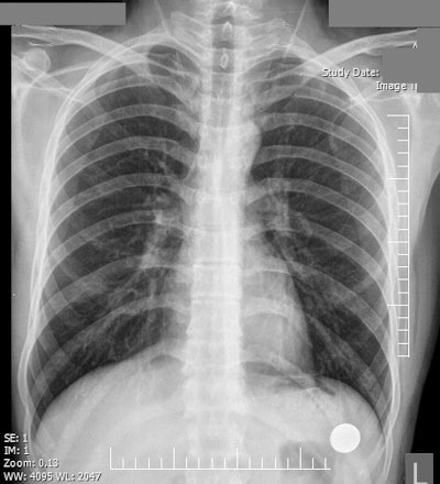 Top: A patient complains of intermittent dyspnea and chest pain. Only 15% of survey participants correctly indicated a normal chest x-ray, and just 44% of study participants claimed prior exposure to a similar image. Image courtesy of Shahid Beheshti University of Medical Sciences. Bottom: A 65-year-old man with a remote history of myocardial infarction presents with worsening dyspnea, shortness of breath, and progressive respiratory distress. The chest x-ray demonstrates bilateral pulmonary hilar vascular engorgement, resulting in 'bat's wing' appearance accompanied by less perceptible prominence of pulmonary vascular markings through the peripheral zones and presence of cardiomegaly. The diagnosis is acute pulmonary edema. Available at chestatlas.com. Reproduced with permission from Chest Atlas.