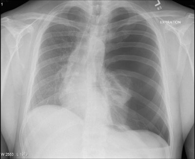 A 29-year-old man presents with severe respiratory distress and hypotension in the setting of persistent left hemithorax pain following a cough attack. The chest x-ray demonstrates loss of pulmonary vascular markings on the left side, leading to its remarkable left hemithoracic translucency associated with left pulmonary total collapse and rightward mediastinal shift. The diagnosis is tension pneumothorax. Available at chestatlas.com. Reproduced with permission from Chest Atlas.