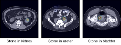Examples of urinary tract stones correctly identified by the algorithm and presented to the user in a color attention map. Images courtesy of Hyunkwang Lee.