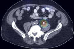 2017 10 03 20 42 3226 Urinarystone Ai 400