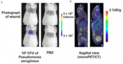Stanford researchers tested the PET tracer 6'-F-18-fluoromaltotriose in a P. aeruginosa wound infection mouse model. Bioluminescence images (A) show the infected wound (left panel) and control mice (right panel). Sagittal slices (B) from a micro-PET/CT scan show the same mice one hour after intravenous administration of 6'-F-18-fluoromaltotriose. Images courtesy of JNM and Dr. Sam Gambhir, PhD, Stanford University.