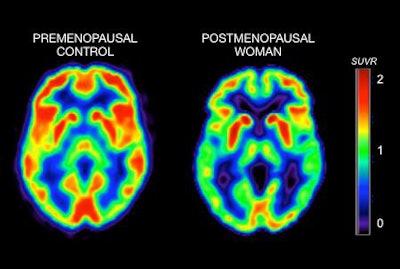 PET images show brain activity in a premenopausal woman (left) and in a postmenopausal woman (right). Brighter colors indicate higher metabolism, while darker colors indicate lower metabolism. The postmenopausal scan appears greener and darker, which means the woman's brain has substantially lower activity (more than 30% less) than the one to the left (no signs of menopause). Images courtesy of Weill Cornell Medicine.