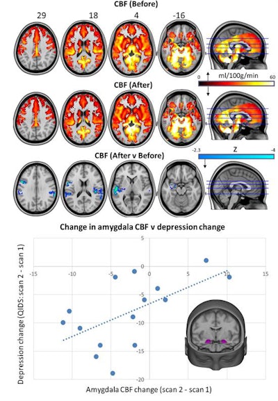 Whole-brain cerebral blood flow maps for baseline versus one-day post-treatment, plus the difference map. Image courtesy of Carhart-Harris et al, Scientific Reports 2017.