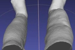 2017 10 17 23 03 2556 Portable Ir Scanner Elephantiasis 20171017231534