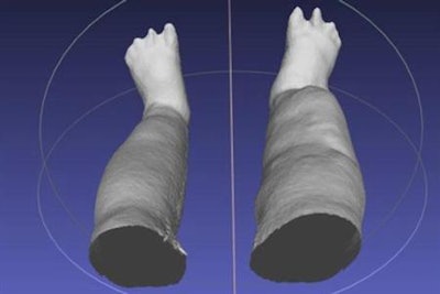 The portable infrared scanning device creates a 3D reconstruction of swollen legs. Image courtesy of Budge et al, Am J Trop Med Hyg 2017.