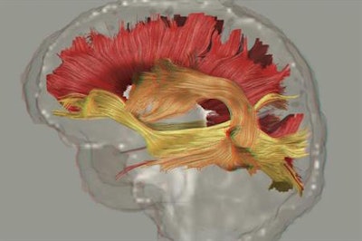 Fiber pathways in the brain are altered in schizophrenia, an illness that may involve hallucinations, psychosis, and depression. Image courtesy of the University of Southern California and Molecular Psychiatry.