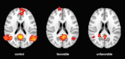 Representative default mode network resting BOLD maps in control subject (left), patient with favorable outcome (center), and patient with unfavorable outcome (right) overlaid onto axial standard Montreal Neurological Institute (MNI) template. The posterior cingulate (MNI: 45, 37, 49) was seeded and voxels with Pearson correlations greater than 0.6 are shown in red-yellow. Image courtesy of Radiology.