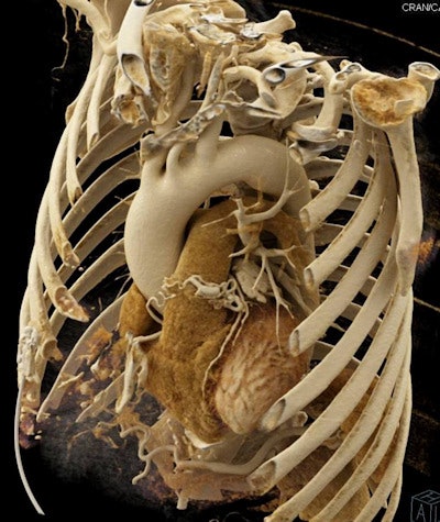 Cinematic rendering of gated CT scan. Image courtesy of Dr. Elliot Fishman.