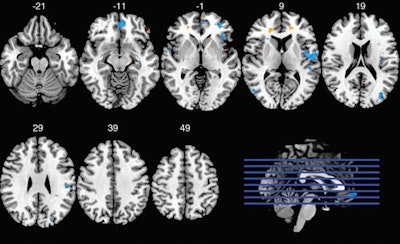 fMRI shows interaction between concussion history and playing position for task-related fMRI BOLD response. Each task level was modeled separately. Clusters with significant interaction (p < 0.001) between concussion history and playing position are overlaid on the Montreal Neuroimaging Institute template brain. Image courtesy of Radiology.