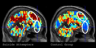 At left is the brain activation pattern for 'death' in participants who had made a suicide attempt. The image at right depicts the activation pattern for 'death' in control participants. Image courtesy of Carnegie Mellon University.