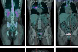 2017 11 09 00 50 6199 Jnm Nsclc Morbelli Image 20171109005420