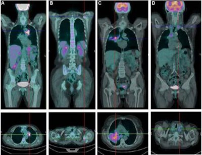 Coronal and transaxial sections of an FDG-PET/CT scan of a 73-year-old woman with stage IV NSCLC show a primary lesion (A) with highly concentrated FDG in the left lung and a small bone lesion in the left scapula (B). An FDG-PET/CT scan of a 70-year-old man with stage IV NSCLC shows a primary lesion (C) with moderately concentrated FDG in the right lung and multiple mediastinal and cervical lymph nodes (D). The female patient (A, B) had lower tumor burden but higher SUVmax than the male patient (C, D). Image courtesy of JNM.