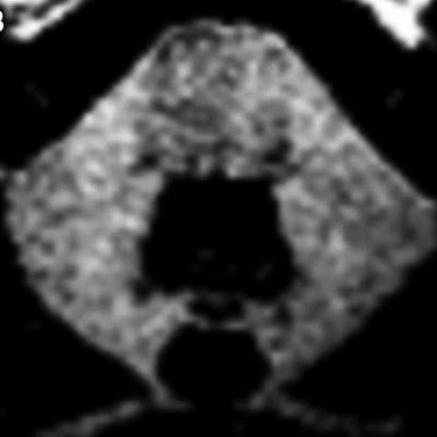 2017 11 13 21 40 7325 Patient 21 Gbca Mri 20171113210712