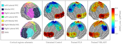 Functional near-infrared spectroscopy brain images of medical students while performing surgery after no training (control), training with a physical simulator (FLS), and training with a virtual simulator (VBLAST). Image courtesy of Arun Nemani.