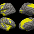 2017 11 20 17 04 8661 Brain Mri Thickness 20171120173438