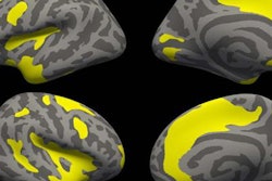 2017 11 20 17 04 8661 Brain Mri Thickness 20171120173438