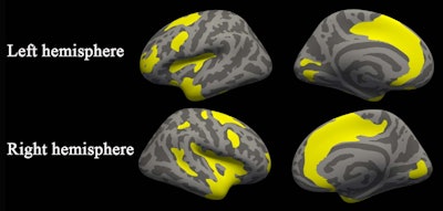 MR image indicating cortical thickness. Image courtesy of the RSNA.