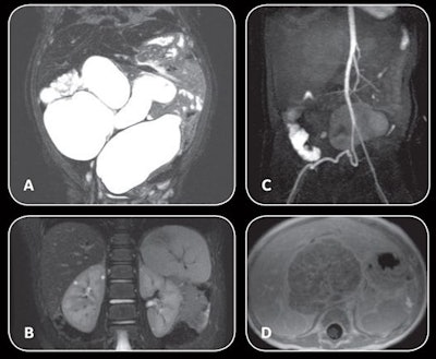 AIR technology coils are lightweight and can wrap around regions of interest, even in cases of severe abdominal pathological findings (A-D) and extreme musculoskeletal deformations. Images courtesy of Dr. Shreyas Vasanawala, PhD.