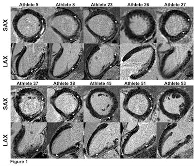 Short- and long-axis images with late gadolinium enhancement depicting a nonischemic fibrosis pattern in all 10 triathletes. The size of late gadolinium enhancement, indicated by arrows, varied from small, point-shaped (triathlete 53) to larger and more distinct (triathletes 5, 8, and 37) areas of fibrosis. Image courtesy of RSNA.