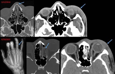 Image of a 21-year-old woman with a chronic nasal bone fracture and soft-tissue swelling on the left side of the face, an oblique fracture of the right ring finger, and a blowout fracture near the left eye socket. Image courtesy of RSNA.