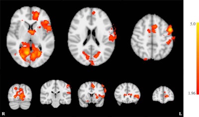 fMRI demonstrates whole-brain effects of neurofeedback training. Image courtesy of RSNA.
