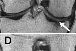 2017 11 23 00 46 7010 Knee Rsna 20171123004233