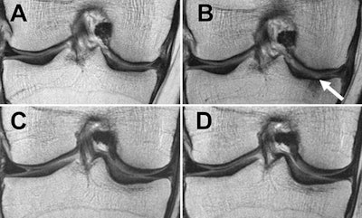 Baseline and follow-up MRIs of the right knee in two women with osteoarthritis, one who lost no weight (A, B) and one who lost weight (C, D). Images courtesy of RSNA.