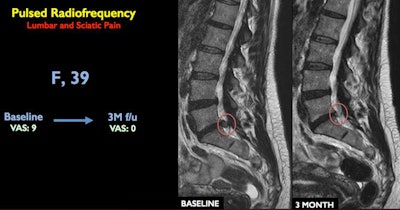 Lumbar spine MRI scan shows vertebra at baseline and three months after treatment. Image courtesy of RSNA.