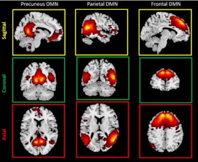 MR images of the brain's default mode network subcomponents. Images courtesy of RSNA.