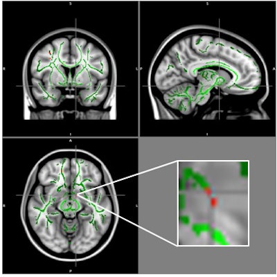 Reduction of fractional anisotropy (FA) in obese patients compared with control group (clusters in red) and FA skeleton (green), superimposed on the mean of FA images in the sample. A cluster of FA decrease is located in the left hypothalamus at the intersection of the alignment vectors. Image courtesy of RSNA.
