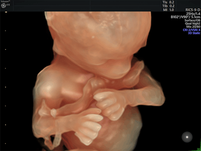 Fetus at 14 weeks with Voluson E10 and HDlive. Image courtesy of GE.