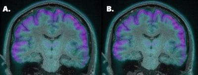 Coronal fused FDG-PET and MR image shows bilateral hypometabolism in the medial temporal lobes. The results from MR-based attenuation correction (A) and CT-based attenuation correction (B) are quite similar. Images courtesy of Dr. Benjamin Kwan.