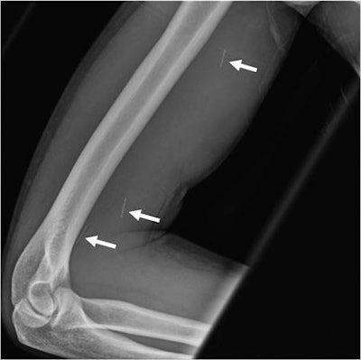 37-year-old man with history of broken needle proximal to the right elbow while injecting heroin. Anterior-posterior x-ray view of right humerus shows three linear hyperdensities in the soft tissues of the arm (arrows). Image courtesy of RSNA.