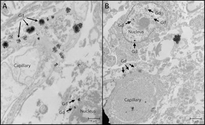 Nuclear localization of gadolinium deposits is shown in transmission electron microscopy images. Cellular localization of gadolinium is evident in the dentate nuclei tissue samples in one gadolinium-exposed patient (A) and another gadolinium-exposed patient (B) at a 2,000- to 10,000-fold magnification. X-ray spectra were collected for selected electron-dense foci (arrows) to verify their identity. Images courtesy of RSNA.