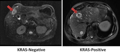 Using tumor radiomic features on MRI, a machine-learning model correctly identified the KRAS mutation status of a KRAS-negative tumor (left) and KRAS-positive tumor (right). Images courtesy of Dr. Dania Daye, PhD.