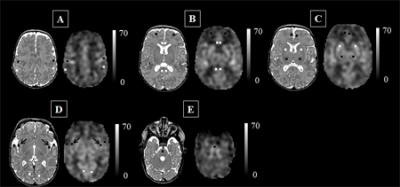 Images show cerebral blood flow maps for a preterm infant scanned at term age without evidence of brain injury. The insula (black arrows in panel D) may be particularly vulnerable to stresses outside the womb. Images courtesy of Bouyssi-Kobar et al., Journal of Pediatrics.